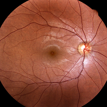 sub-header-images-445x445-diabetic-retinopathy